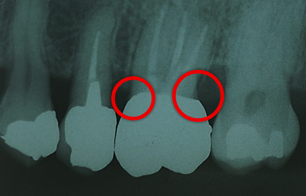 歯とかぶせ物との境界線