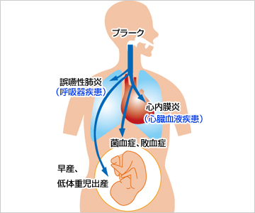 歯肉炎・歯周病とは
