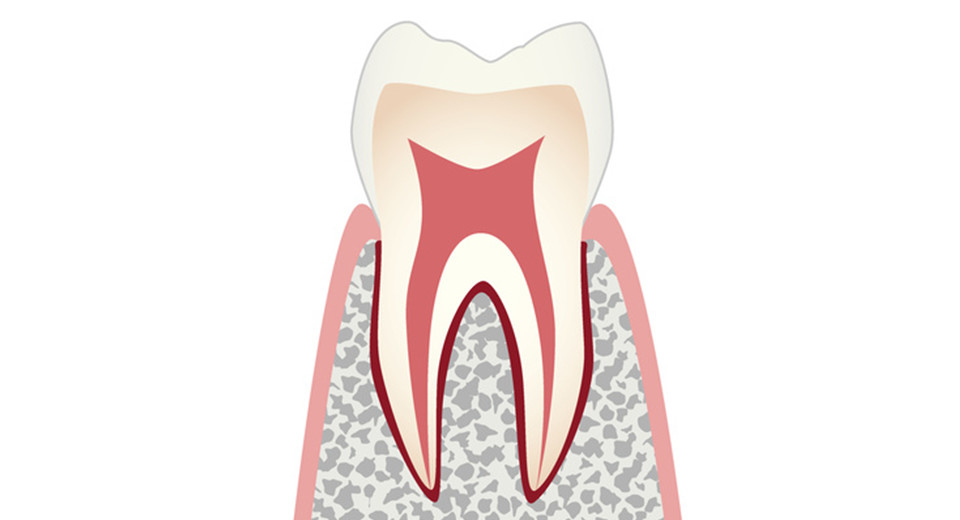 CO：歯を削らなくて済む場合のある、ごく初期の段階です。歯の溝が変色してきますが、痛みなどの自覚症状はありません。