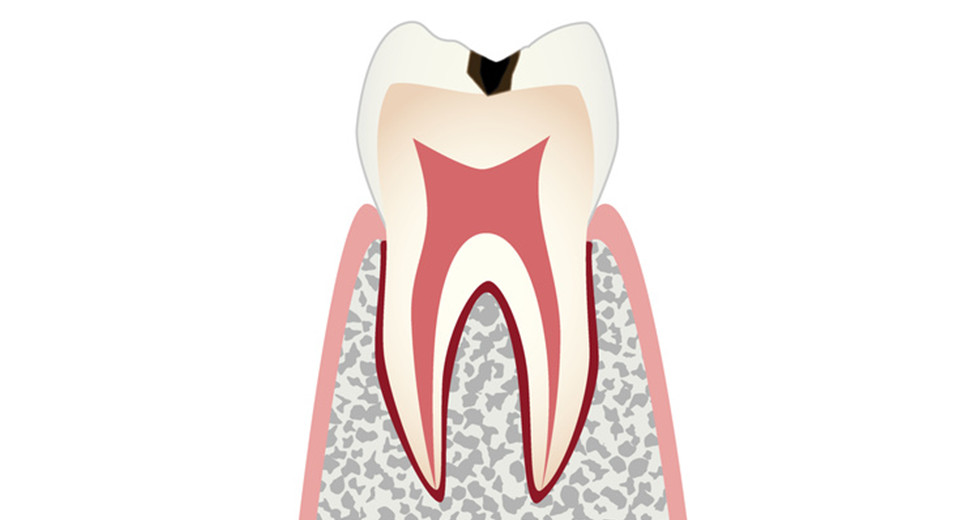 C1：歯の表面のエナメル質が溶かされて穴があいてきます。また痛みは出ませんが、この段階以降は虫歯部分を削って詰め物をする治療を行ないます。