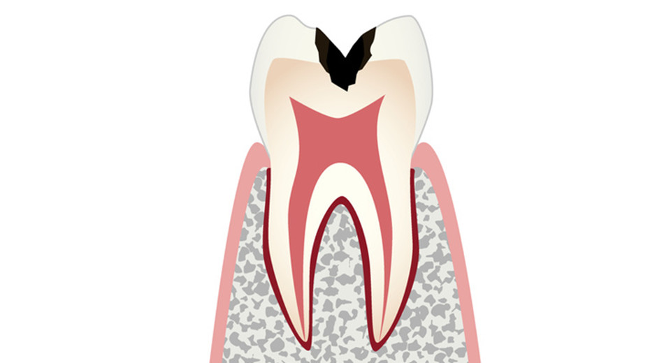 C2：エナメル質より下の象牙質まで、虫歯が進行した段階です。冷たいものがしみたり、痛みを感じることもあります。