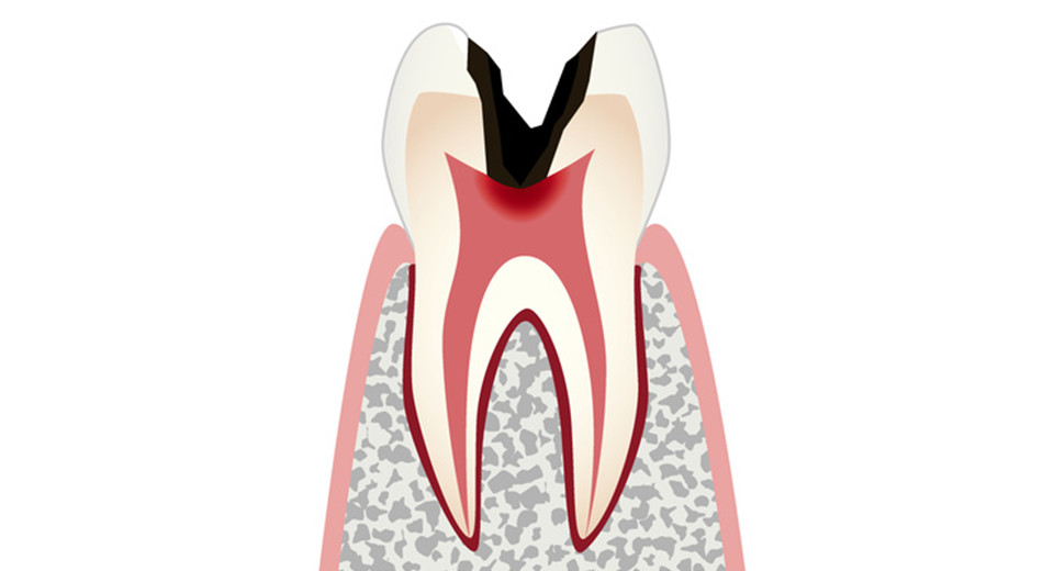 C3：虫歯が歯の歯髄（神経）にまで進行し、ズキズキとした強い痛みを感じます。歯肉が腫れ、膿が出ることもあります。深刻な場合には、歯髄を取り除く必要も出てきます。