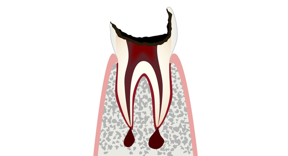 C4：歯の深部にまで虫歯が到達した段階です。神経が死んでしまうので痛みが治まることがありますが、歯根の先に膿が溜まって炎症を起こすと、再び激しい痛みが出ます。この段階になると歯を残すことは難しく、抜歯をして入れ歯やブリッジ、インプラント治療を行ないます。