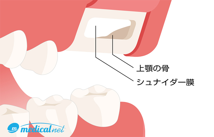 サイナスリフト法