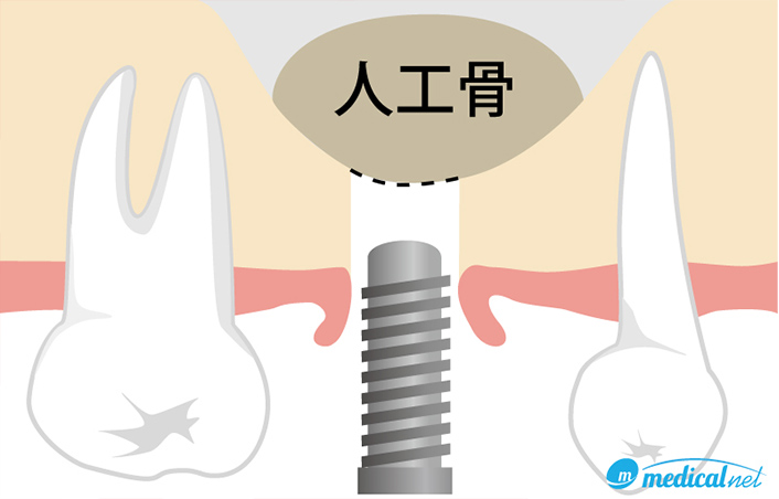 ソケットリフト法