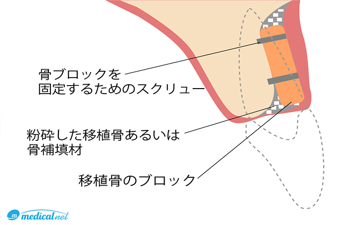 ベニアグラフト法（ブロック骨移植）