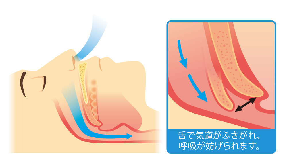 睡眠時無呼吸症候群とは