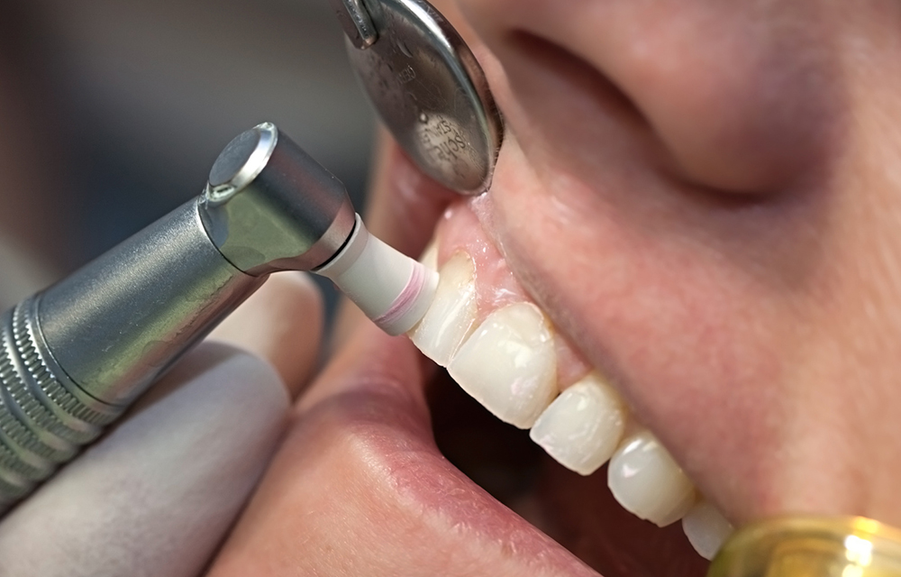 PMTC(Professional Mechanical Tooth Cleaning)
